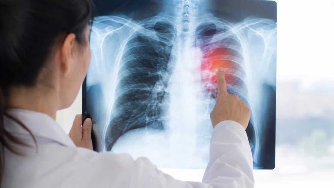 Healthy, Young, and Never Smoked? New Study Explores Why Lung Cancer Still Occurs